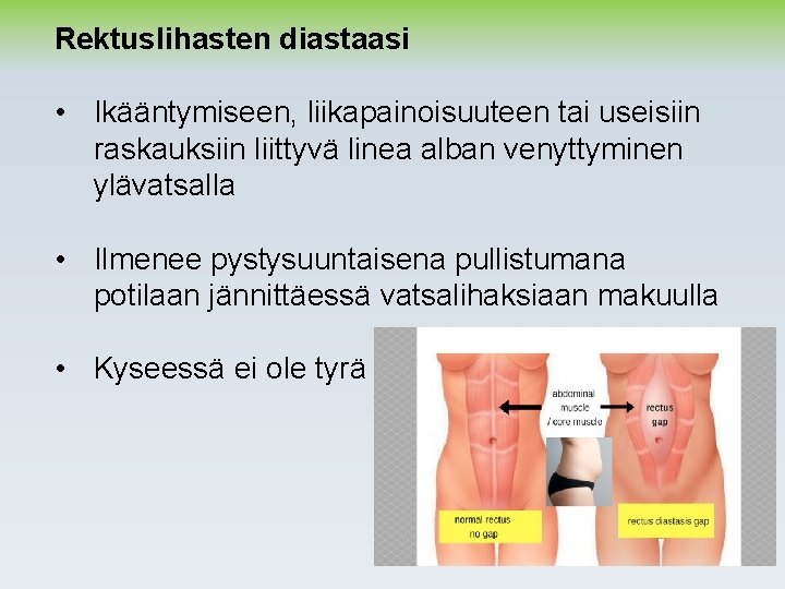 Rektuslihasten diastaasi • Ikääntymiseen, liikapainoisuuteen tai useisiin raskauksiin liittyvä linea alban venyttyminen ylävatsalla •