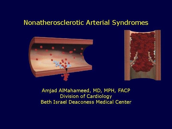 Nonatherosclerotic Arterial Syndromes Amjad Al. Mahameed, MD, MPH, FACP Division of Cardiology Beth Israel