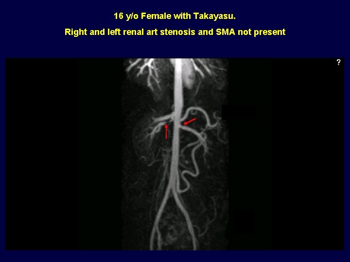 16 y/o Female with Takayasu. Right and left renal art stenosis and SMA not