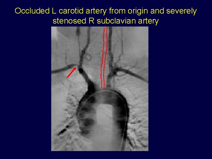 Occluded L carotid artery from origin and severely stenosed R subclavian artery 