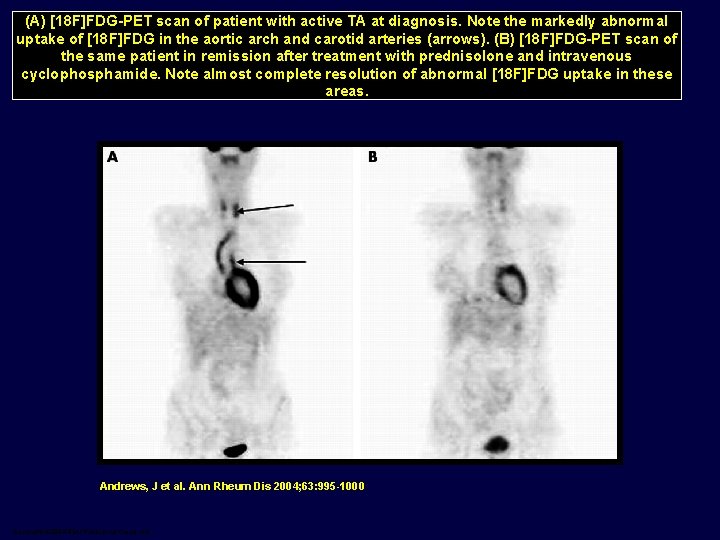 (A) [18 F]FDG-PET scan of patient with active TA at diagnosis. Note the markedly