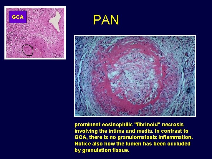 GCA PAN prominent eosinophilic "fibrinoid" necrosis involving the intima and media. In contrast to