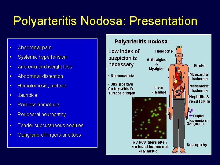 Polyarteritis Nodosa: Presentation Polyarteritis nodosa • Abdominal pain • Systemic hypertension • Anorexia and