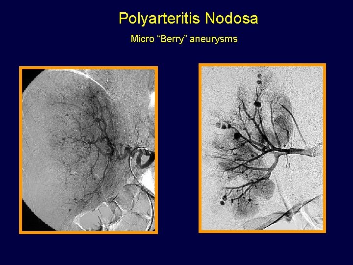 Polyarteritis Nodosa Micro “Berry” aneurysms 