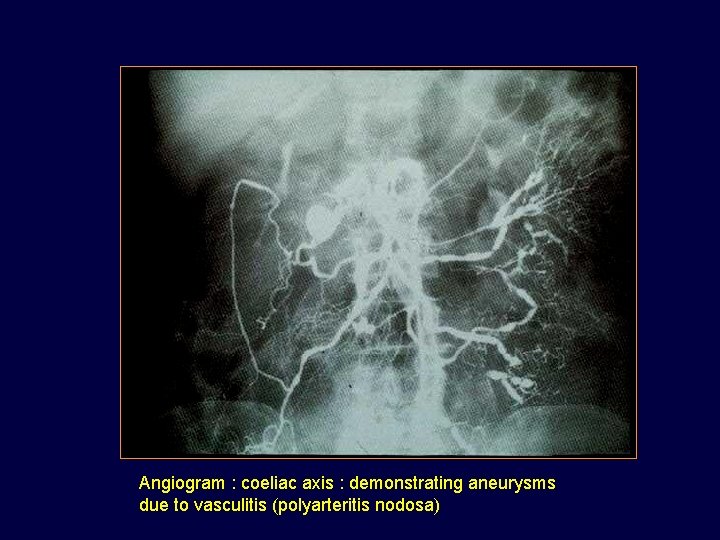 Angiogram : coeliac axis : demonstrating aneurysms due to vasculitis (polyarteritis nodosa) 