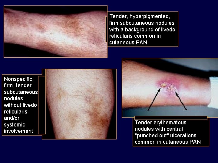 Tender, hyperpigmented, firm subcutaneous nodules with a background of livedo reticularis common in cutaneous