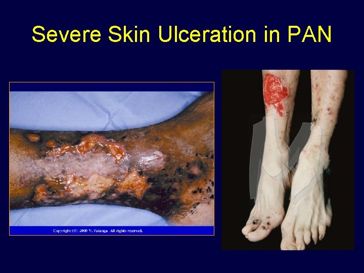 Severe Skin Ulceration in PAN 