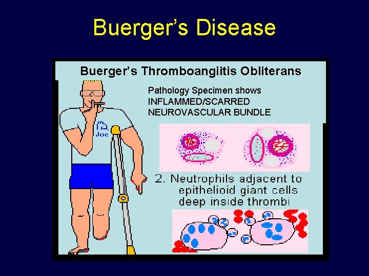 Buerger’s Disease Buerger’s Thromboangiitis Obliterans Pathology Specimen shows INFLAMMED/SCARRED NEUROVASCULAR BUNDLE 