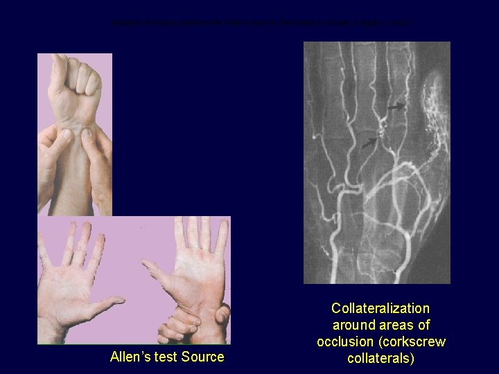 example of how to perform the Allen’s test on the hands is shown in