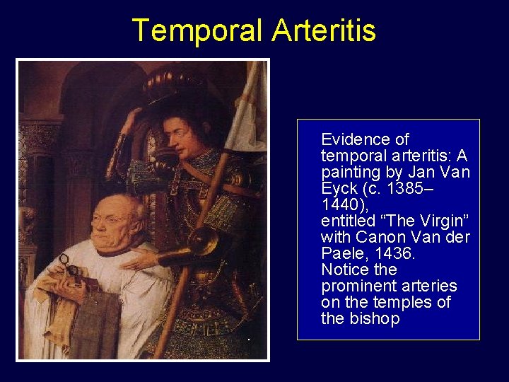 Temporal Arteritis Evidence of temporal arteritis: A painting by Jan Van Eyck (c. 1385–