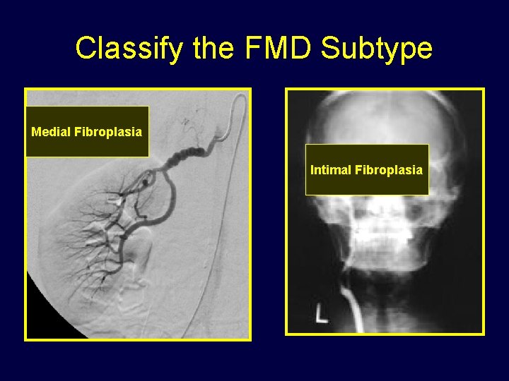 Classify the FMD Subtype Medial Fibroplasia Intimal Fibroplasia 