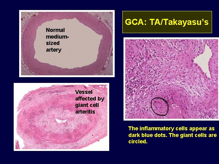 GCA: TA/Takayasu’s Normal mediumsized artery Vessel affected by giant cell arteritis The inflammatory cells