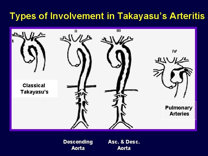 Types of Involvement in Takayasu’s Arteritis Classical Takayasu’s Pulmonary Arteries Descending Aorta Asc. &