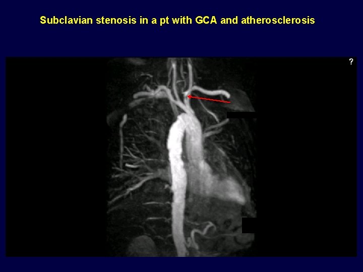 Subclavian stenosis in a pt with GCA and atherosclerosis 