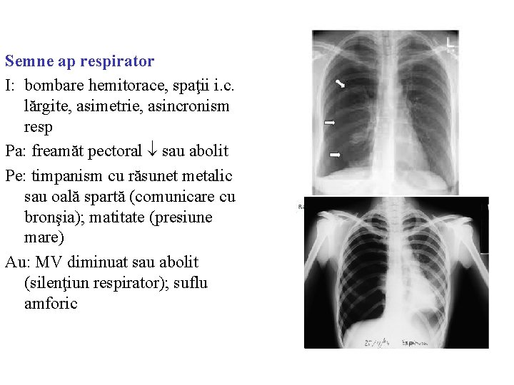 Semne ap respirator I: bombare hemitorace, spaţii i. c. lărgite, asimetrie, asincronism resp Pa: