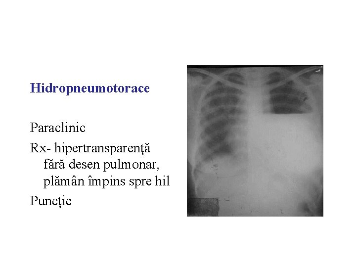 Hidropneumotorace Paraclinic Rx- hipertransparenţă fără desen pulmonar, plămân împins spre hil Puncţie 