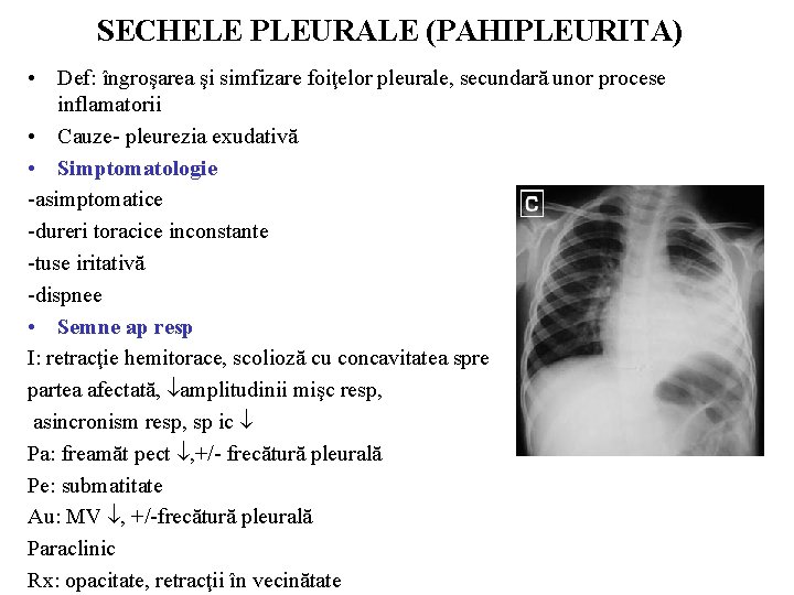 SECHELE PLEURALE (PAHIPLEURITA) • Def: îngroşarea şi simfizare foiţelor pleurale, secundară unor procese inflamatorii