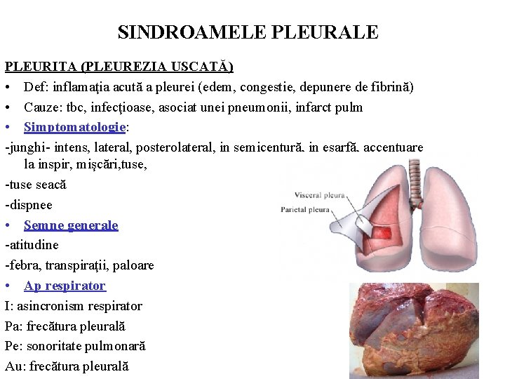 SINDROAMELE PLEURALE PLEURITA (PLEUREZIA USCATĂ) • Def: inflamaţia acută a pleurei (edem, congestie, depunere