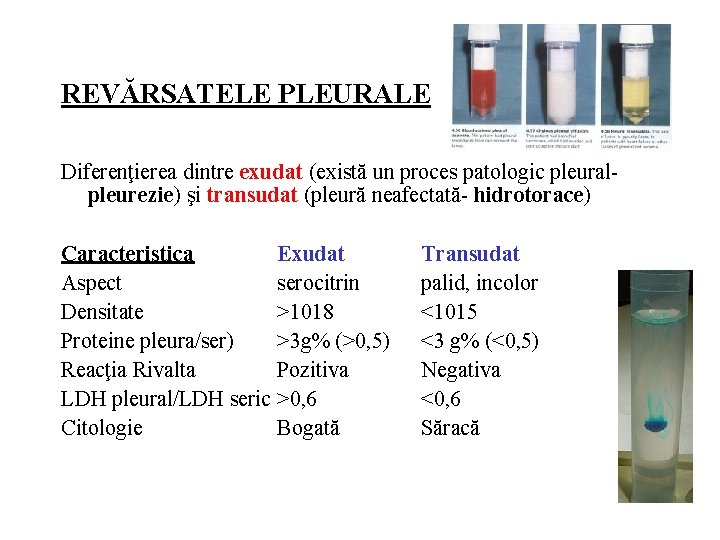 REVĂRSATELE PLEURALE Diferenţierea dintre exudat (există un proces patologic pleuralpleurezie) şi transudat (pleură neafectată-