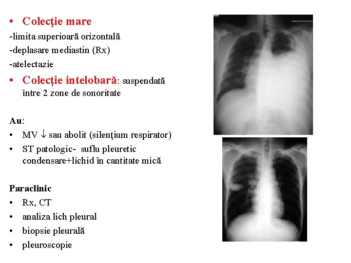 • Colecţie mare -limita superioară orizontală -deplasare mediastin (Rx) -atelectazie • Colecţie intelobară: