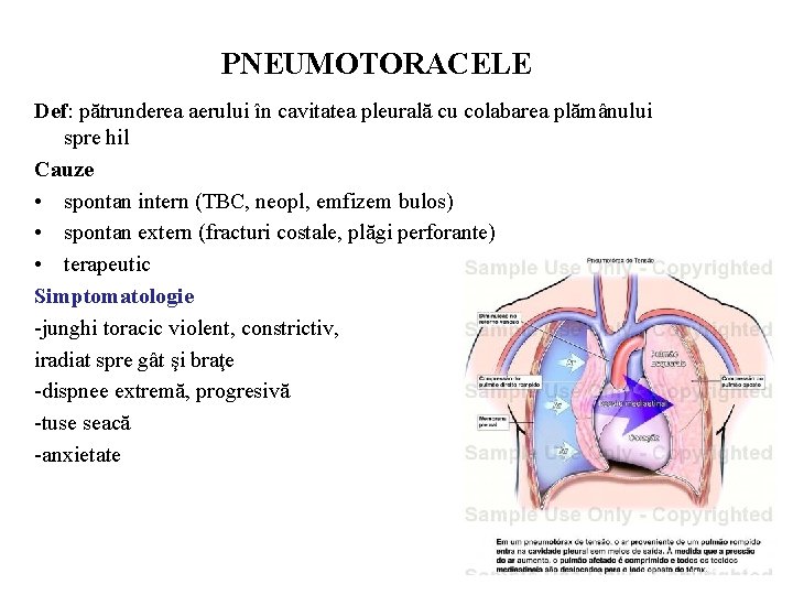 PNEUMOTORACELE Def: pătrunderea aerului în cavitatea pleurală cu colabarea plămânului spre hil Cauze •