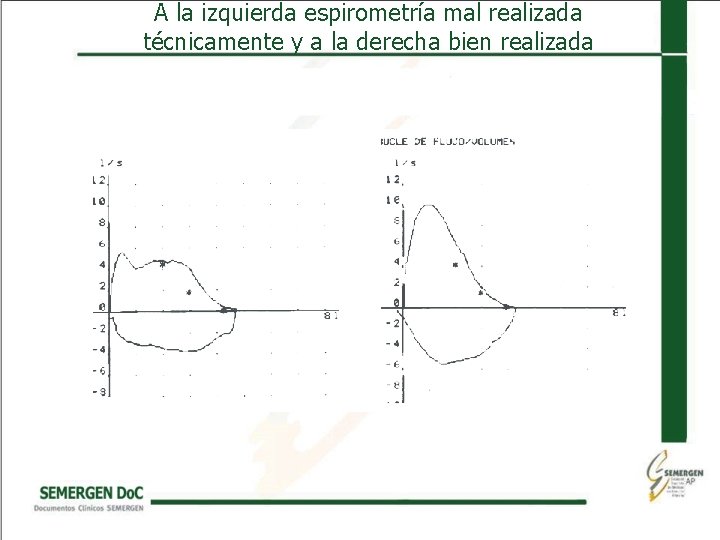 A la izquierda espirometría mal realizada técnicamente y a la derecha bien realizada 