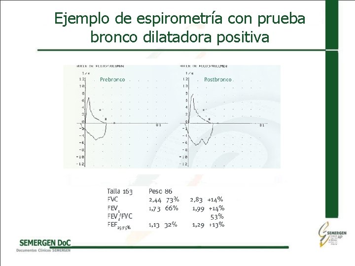 Ejemplo de espirometría con prueba bronco dilatadora positiva 