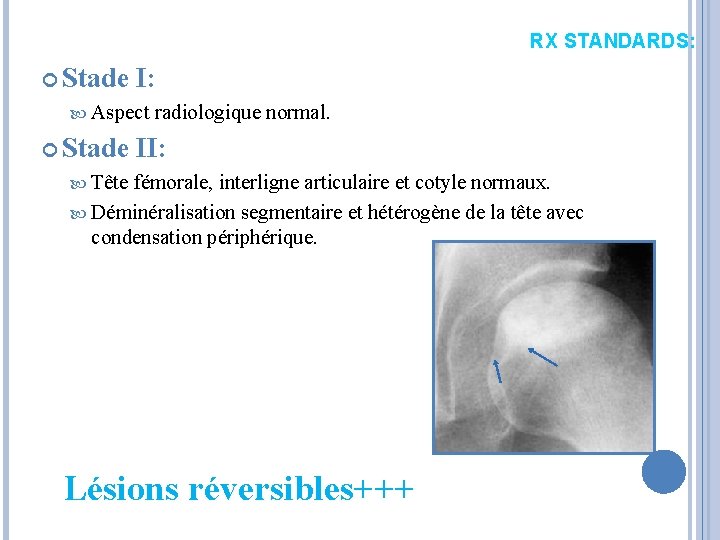 RX STANDARDS: Stade I: Aspect Stade radiologique normal. II: Tête fémorale, interligne articulaire et