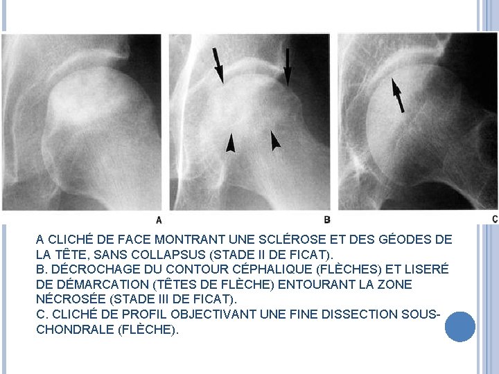 A CLICHÉ DE FACE MONTRANT UNE SCLÉROSE ET DES GÉODES DE LA TÊTE, SANS