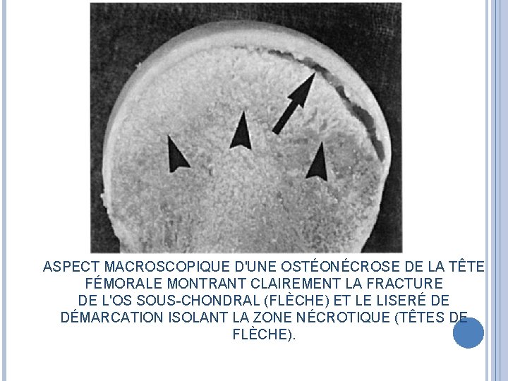 ASPECT MACROSCOPIQUE D'UNE OSTÉONÉCROSE DE LA TÊTE FÉMORALE MONTRANT CLAIREMENT LA FRACTURE DE L'OS