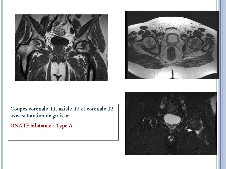 Coupes coronale T 1, axiale T 2 et coronale T 2 avec saturation de