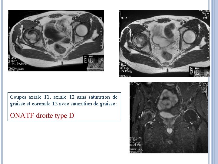 Coupes axiale T 1, axiale T 2 sans saturation de graisse et coronale T