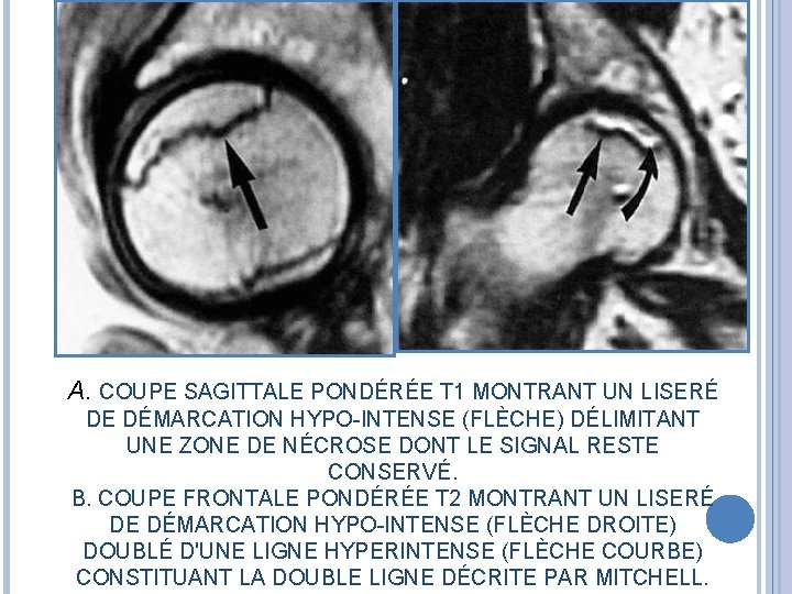 A. COUPE SAGITTALE PONDÉRÉE T 1 MONTRANT UN LISERÉ DE DÉMARCATION HYPO-INTENSE (FLÈCHE) DÉLIMITANT