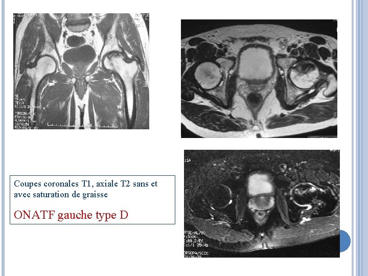 Coupes coronales T 1, axiale T 2 sans et avec saturation de graisse ONATF