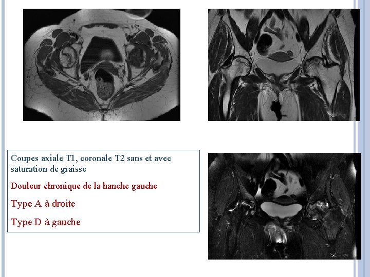 Coupes axiale T 1, coronale T 2 sans et avec saturation de graisse Douleur