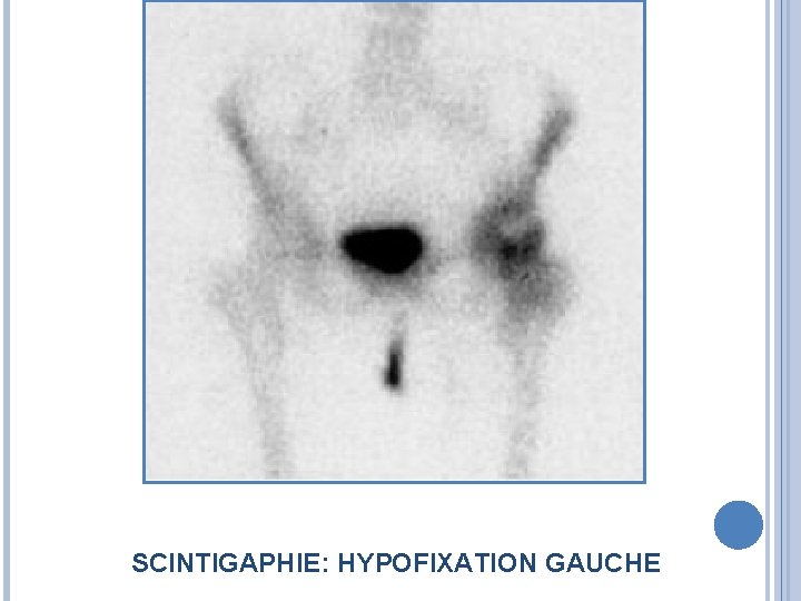 SCINTIGAPHIE: HYPOFIXATION GAUCHE 