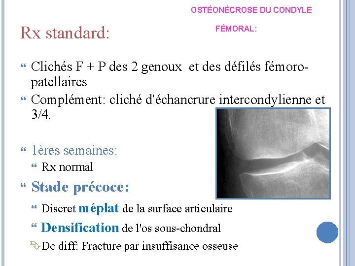 OSTÉONÉCROSE DU CONDYLE Rx standard: Clichés F + P des 2 genoux et des