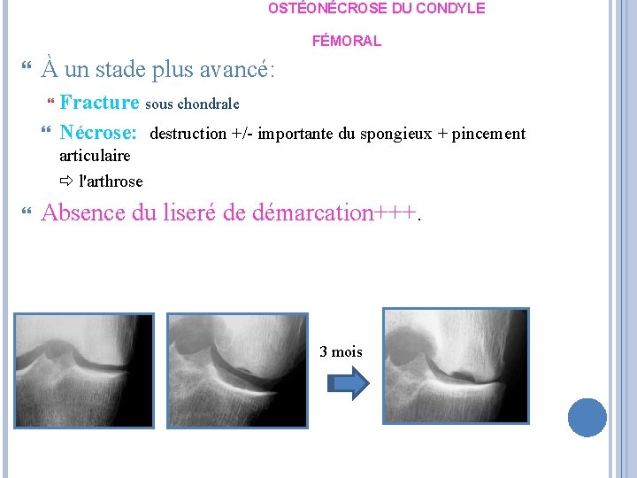 OSTÉONÉCROSE DU CONDYLE FÉMORAL À un stade plus avancé: Fracture sous chondrale Nécrose: destruction