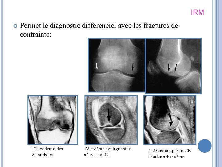 IRM Permet le diagnostic différenciel avec les fractures de contrainte: T 1: oedème des