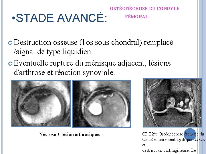 OSTÉONÉCROSE DU CONDYLE • STADE AVANCÉ: FÉMORAL: Destruction osseuse (l'os sous chondral) remplacé /signal