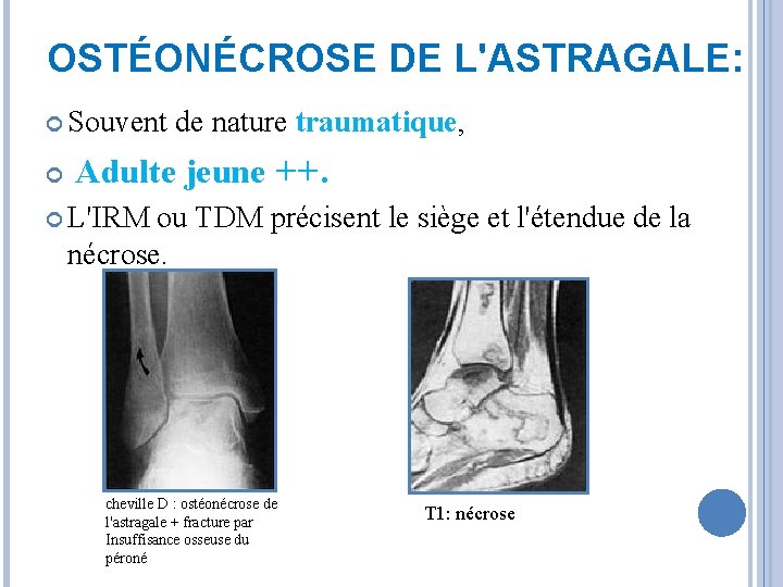 OSTÉONÉCROSE DE L'ASTRAGALE: Souvent de nature traumatique, Adulte jeune ++. L'IRM ou TDM précisent