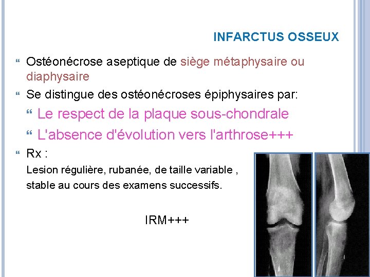 INFARCTUS OSSEUX Ostéonécrose aseptique de siège métaphysaire ou diaphysaire Se distingue des ostéonécroses épiphysaires