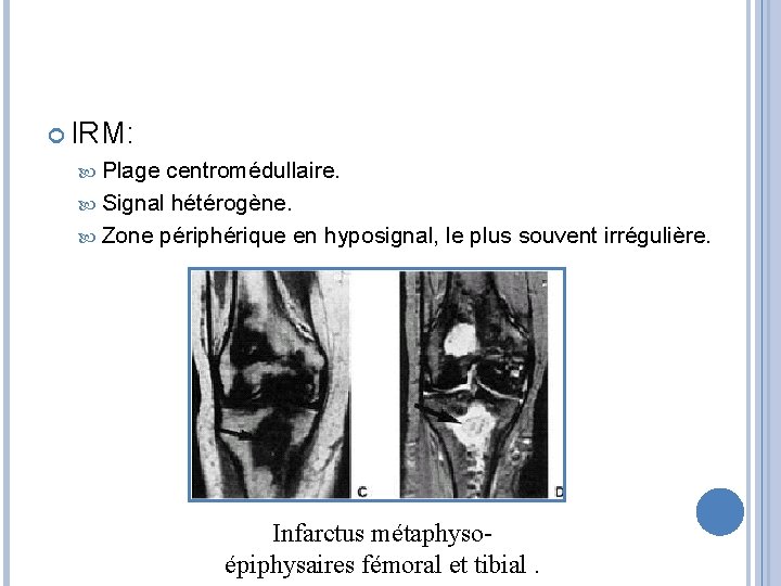  IRM: Plage centromédullaire. Signal hétérogène. Zone périphérique en hyposignal, le plus souvent irrégulière.