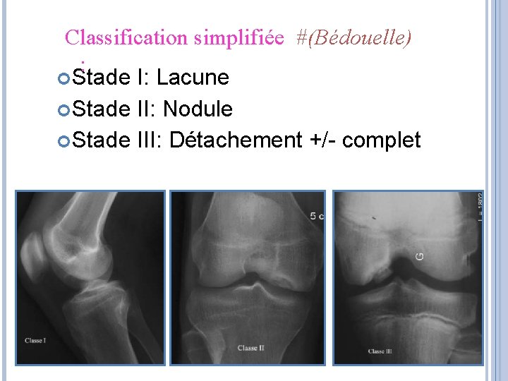 Classification simplifiée #(Bédouelle) : Stade I: Lacune Stade II: Nodule Stade III: Détachement +/- Classification simplifiée #(Bédouelle) : Stade I: Lacune Stade II: Nodule Stade III: Détachement +/-