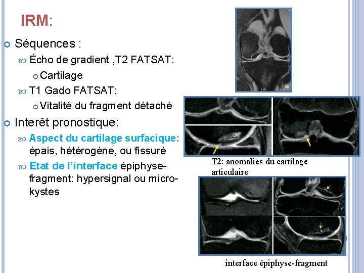 IRM: Séquences : Écho de gradient , T 2 FATSAT: Cartilage T 1 Gado
