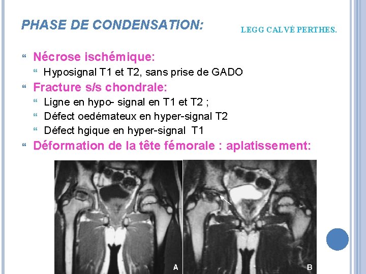 PHASE DE CONDENSATION: Nécrose ischémique: LEGG CALVÉ PERTHES. Hyposignal T 1 et T 2,