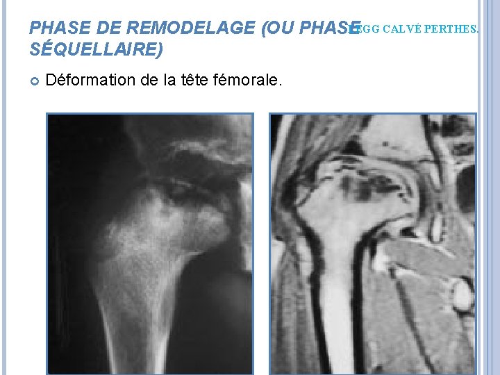 LEGG CALVÉ PERTHES. PHASE DE REMODELAGE (OU PHASE SÉQUELLAIRE) Déformation de la tête fémorale. LEGG CALVÉ PERTHES. PHASE DE REMODELAGE (OU PHASE SÉQUELLAIRE) Déformation de la tête fémorale.