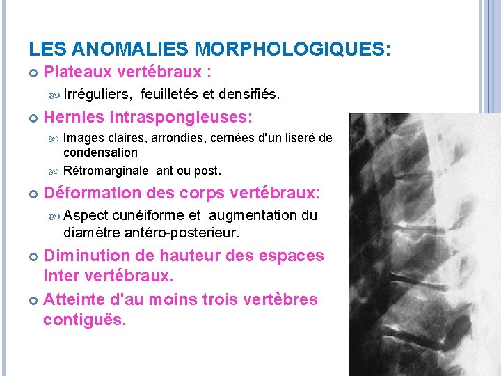 LES ANOMALIES MORPHOLOGIQUES: Plateaux vertébraux : Irréguliers, feuilletés et densifiés. Hernies intraspongieuses: Images claires,