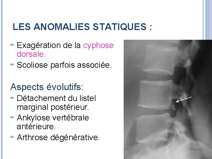 LES ANOMALIES STATIQUES : Exagération de la cyphose dorsale. Scoliose parfois associée. Aspects évolutifs: