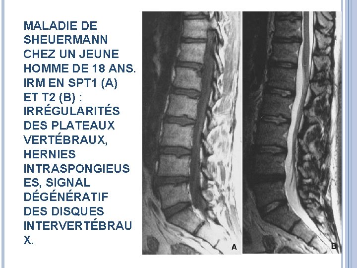 MALADIE DE SHEUERMANN CHEZ UN JEUNE HOMME DE 18 ANS. IRM EN SPT 1